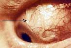 Loa loa on the eye