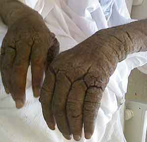 Norwegian scabies a.k.a. crusted scabies