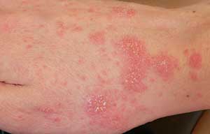 scabies day 8 - treatment begins